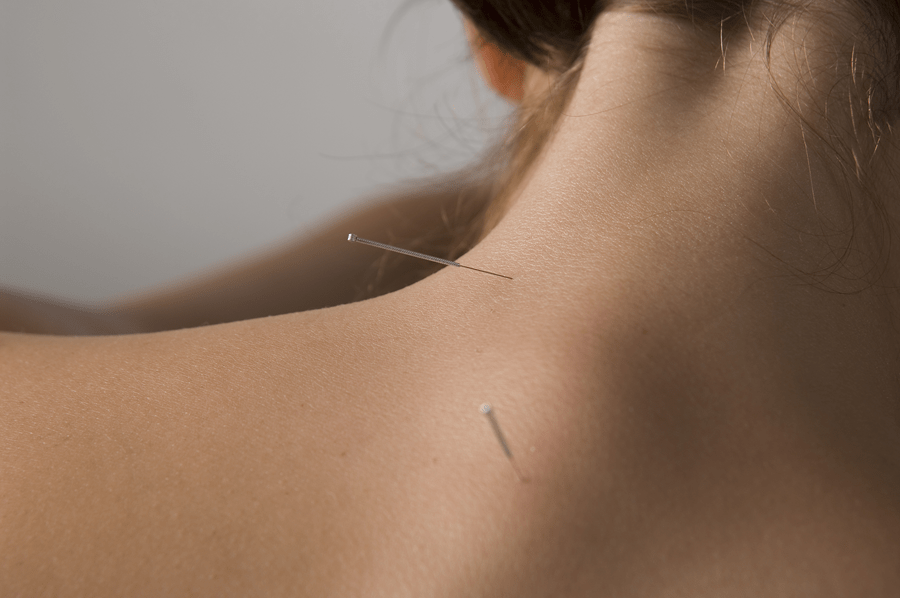 Needle Upper Back