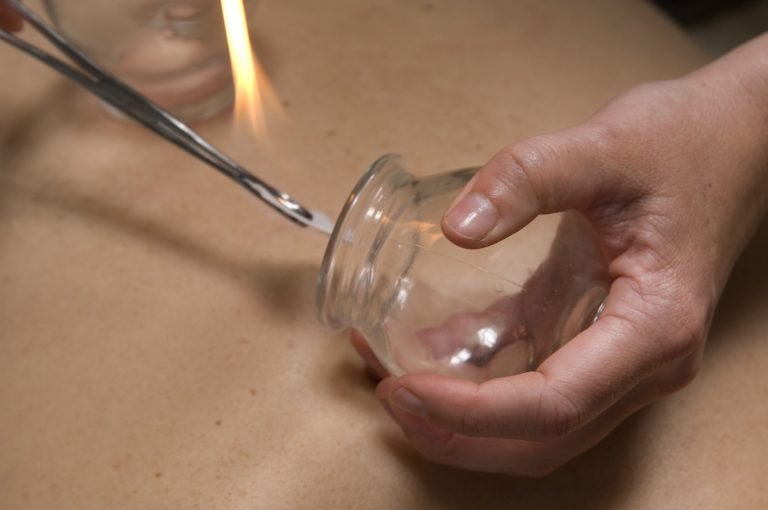 Preparing for cupping