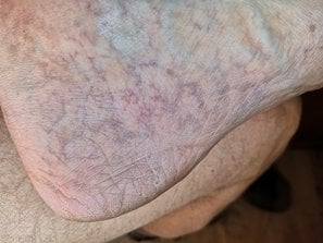 Heel Blood Stasis Veins