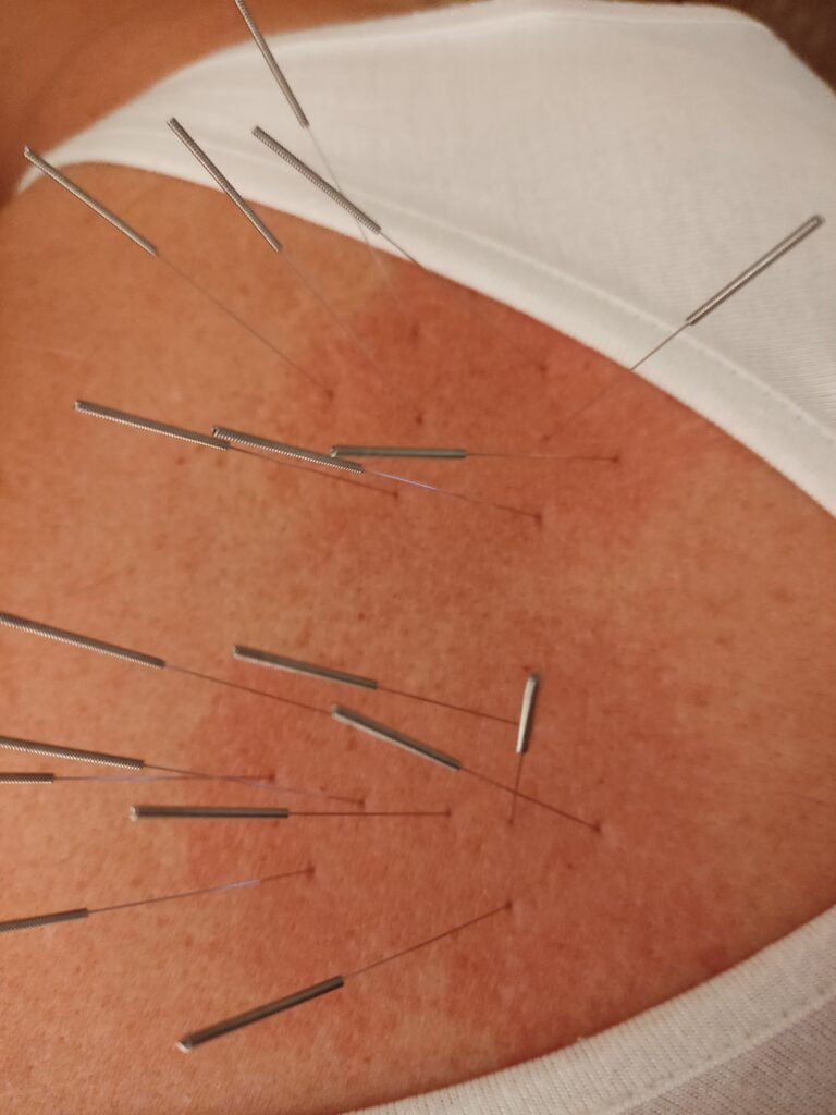 Back-shu points inflammation