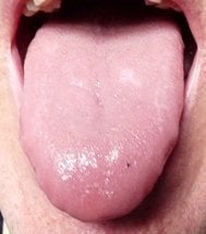 Tongue pale and moist suggesting a Cold condition.