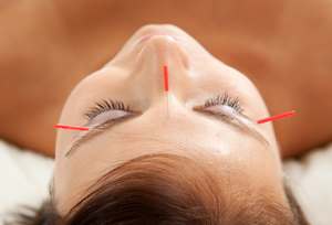 cosmetic acupuncture
