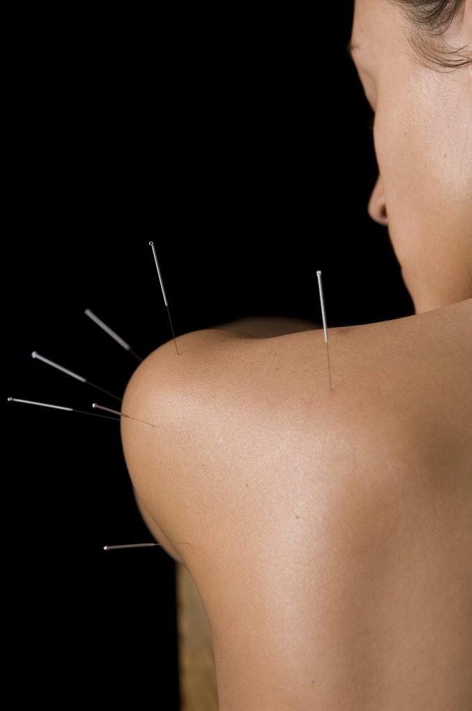 Acupuncture