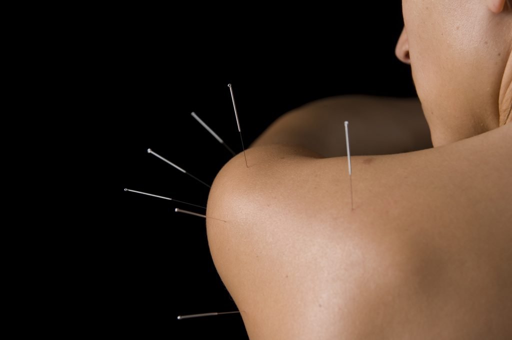 acupuncture medicine