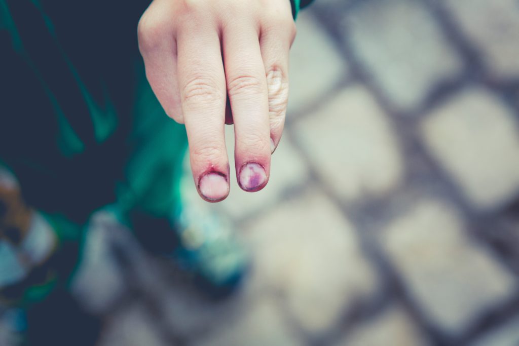 Swelling round fingernails show damp. Probably sore, too.