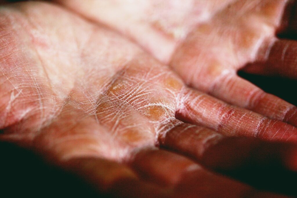Skin dryness on hands - may or may not be eczema
